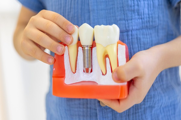 Reasons To Choose Implants For Tooth Restoration